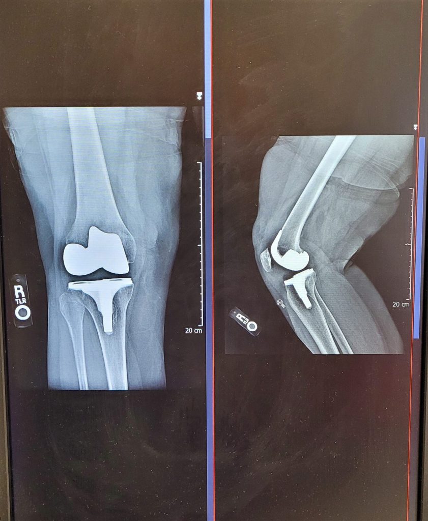 xray orthopedic surgery full knee joint replacem 2021 10 05 05 50 57 utc scaled 1